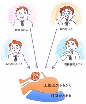 睡眠時無呼吸症候群「睡眠時無呼吸症候群ってどんな病気？」画像
